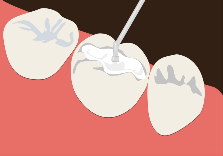 bha-free-fillings