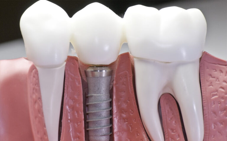 dental-implants-