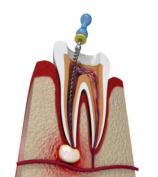 depositphotos_268806752-stock-photo-root-canal-treatment-process-illustration