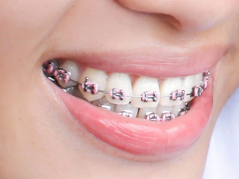 desktop-wallpaper-braces-braces