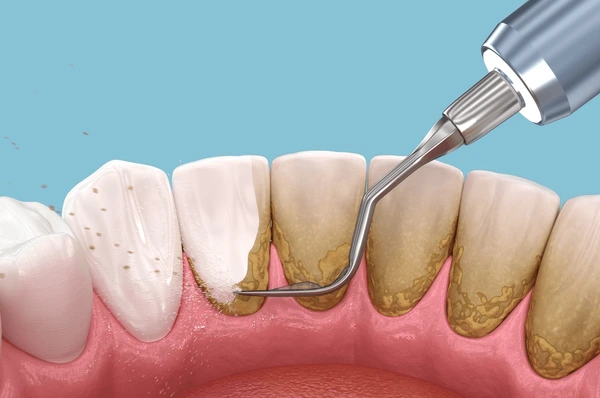 oral-hygiene-scaling-root-planing-600nw-2344703933